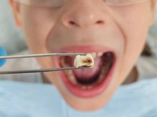 Best Emergency Tooth Extraction in Elsa, TX